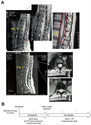 Case report: Combined transcutaneous spinal cord stimulation and physical therapy on recovery of neurological function after spinal cord infarction